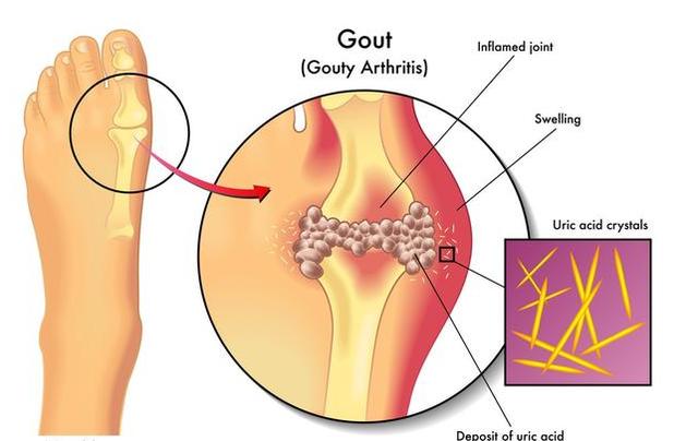 痛风会疼一个月吗？