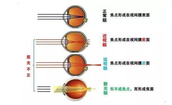 广东省广州近视能手术，全面解析近视矫正手术在广州的现状与未来