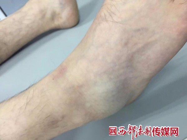 脚跟粉碎骨折9个月后的康复之路