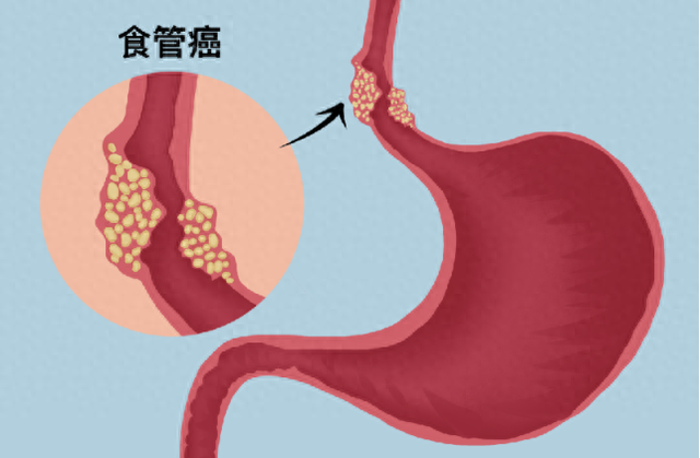 最新食管癌研究进展，从预防到治疗的全面解析